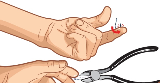 How to Remove a Fishhook From Your Hand Without Making it Worse – Scout  Life magazine