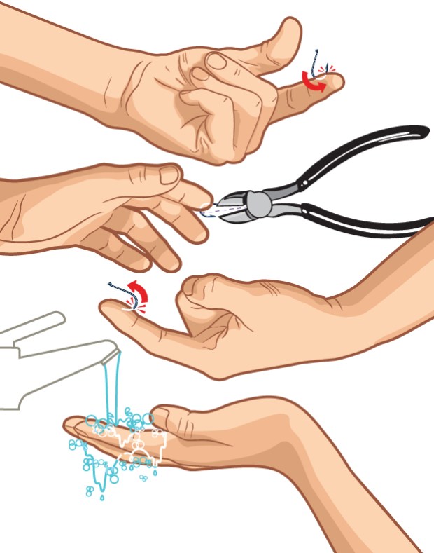 How to Remove a Fishhook From Your Hand Without Making it Worse